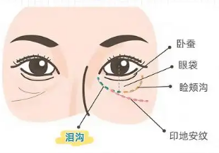 眼袋