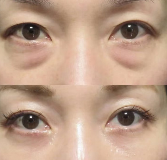 眼袋
