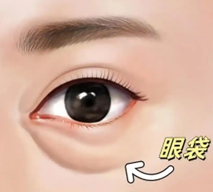 眼袋