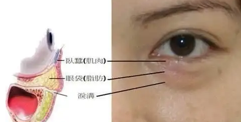 眼袋