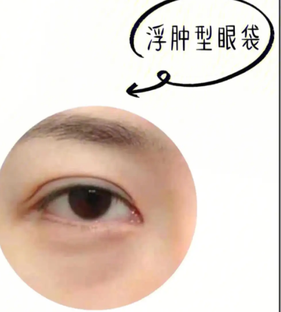 眼袋