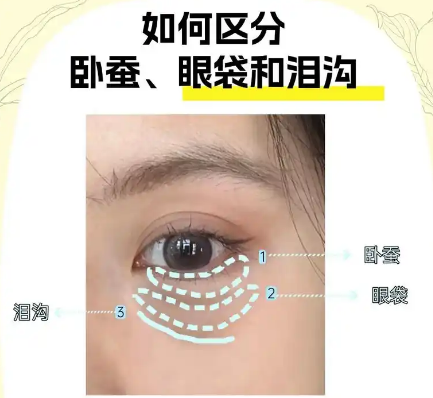 眼袋