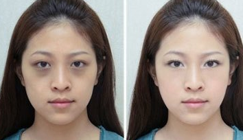 眼袋