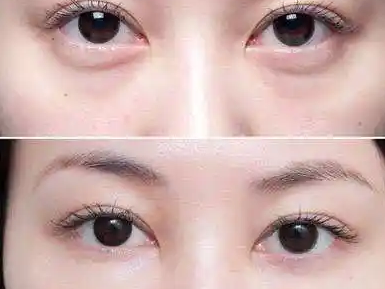 眼袋