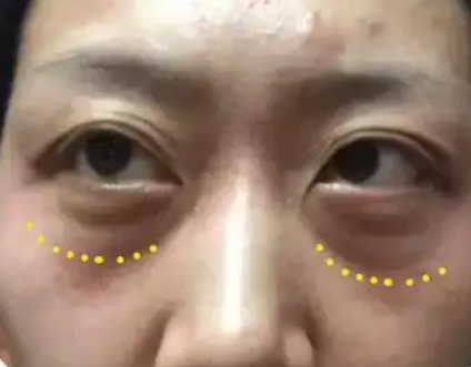 眼袋