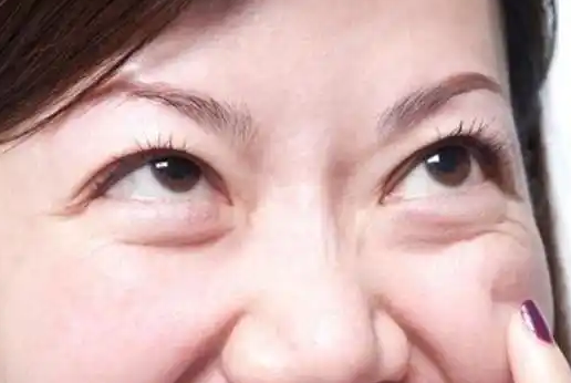 眼袋