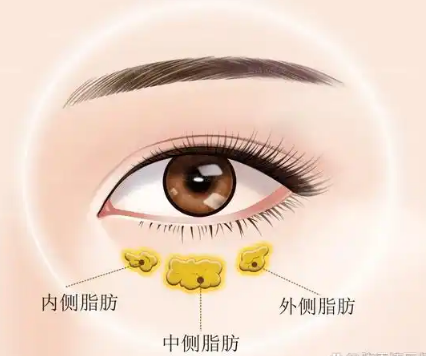 去眼袋手术