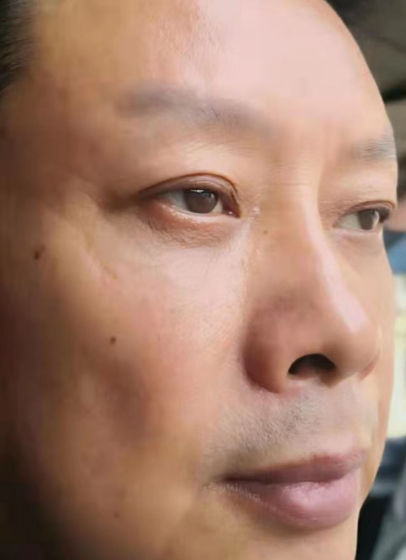 去眼袋手术