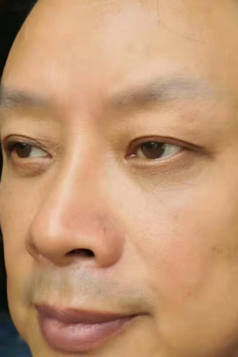 去眼袋手术