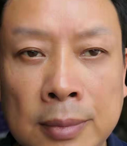 去眼袋手术