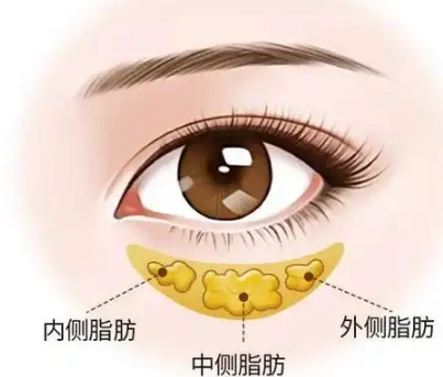 眼袋
