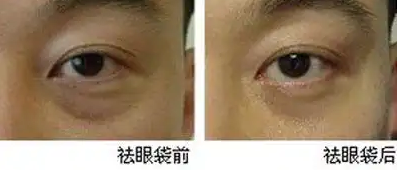 眼袋