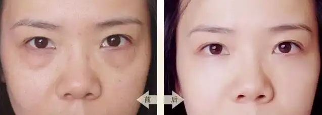 眼袋