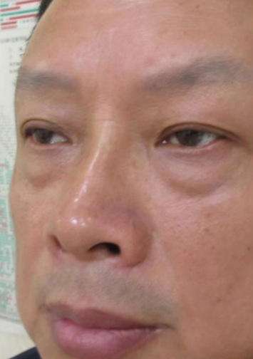 去眼袋手术