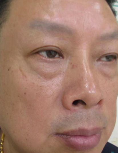 去眼袋手术