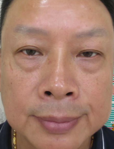 去眼袋手术