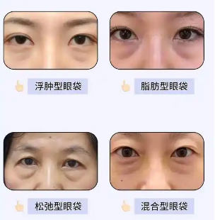 去眼袋手术
