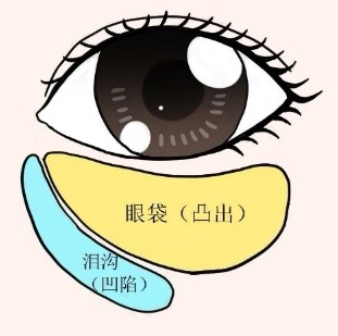 去眼袋手术