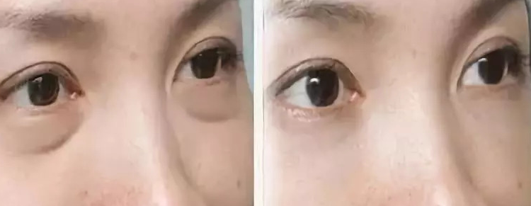 眼袋