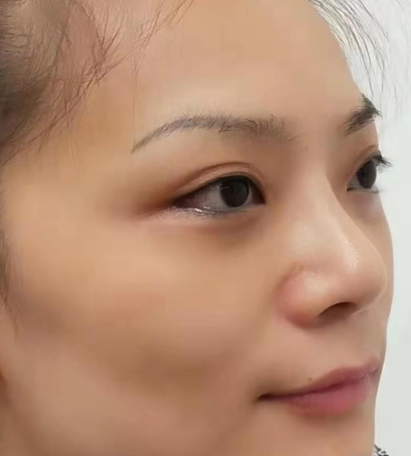 去眼袋手术