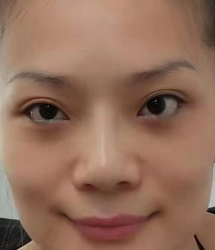 去眼袋手术