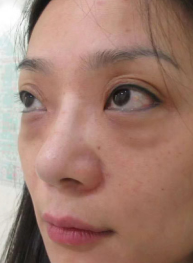 去眼袋手术