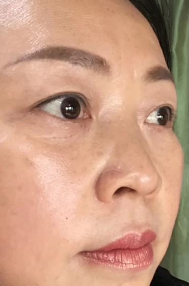 去眼袋手术