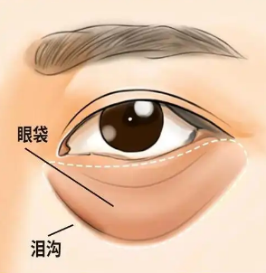 去眼袋手术
