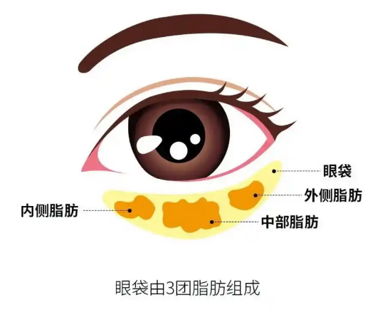 去眼袋手术