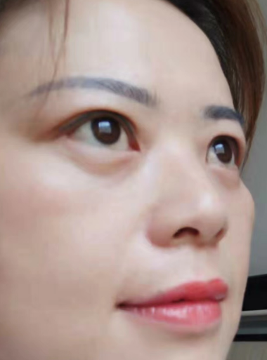 去眼袋手术
