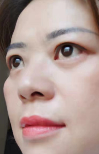 去眼袋手术