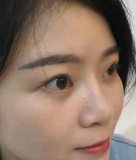 去眼袋手术