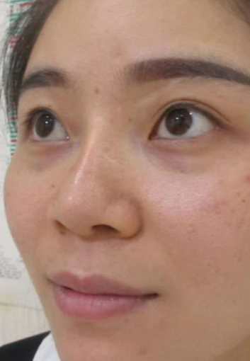去眼袋手术