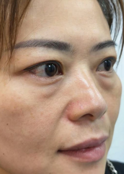 去眼袋手术