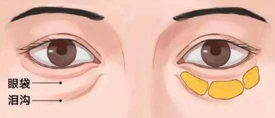 去眼袋手术
