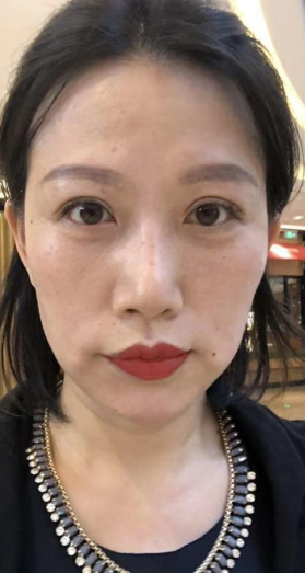 去眼袋手术