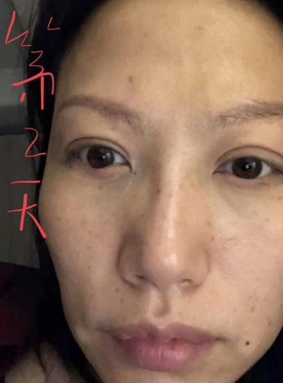去眼袋手术
