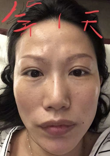 去眼袋手术