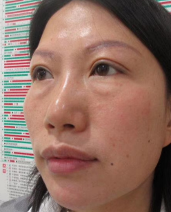 去眼袋手术