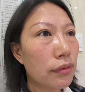 去眼袋手术