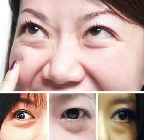 去眼袋手术