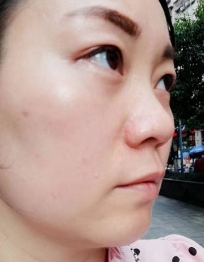 去眼袋手术