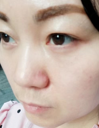 去眼袋手术