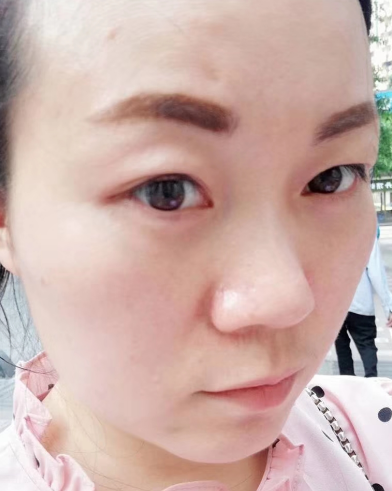 去眼袋手术