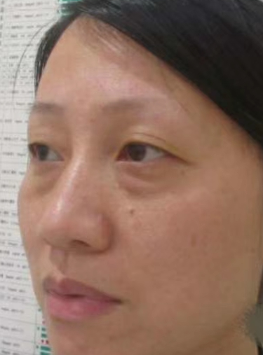 去眼袋手术