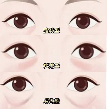 去眼袋手术