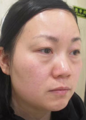 去眼袋手术