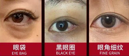 眼袋