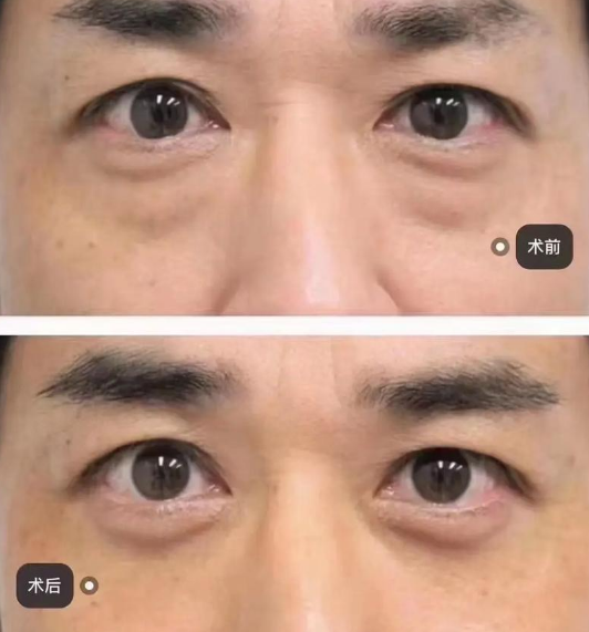 眼袋