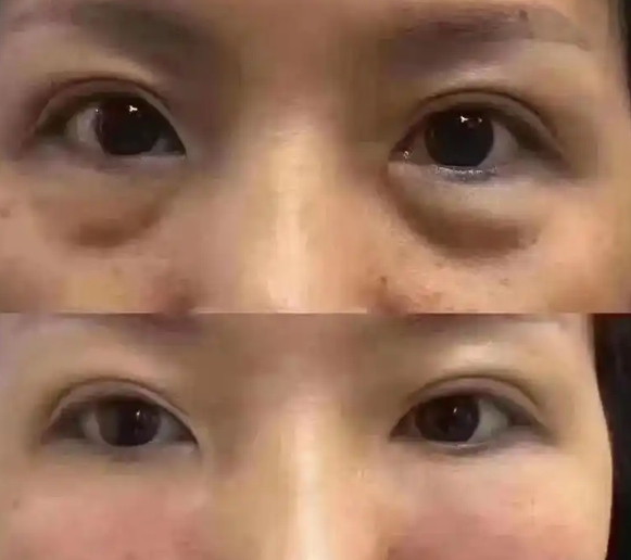 眼袋